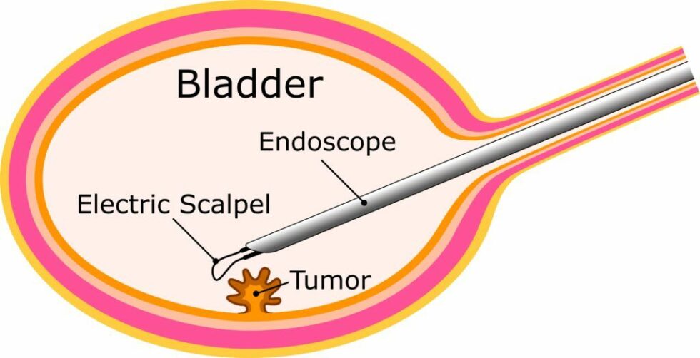 Transurethral Resection of Bladder Tumour | Northern Beaches Urology